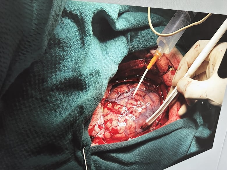 Photo of brain surgery.